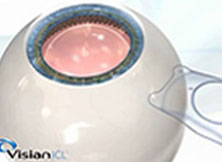 角膜缘切一小口