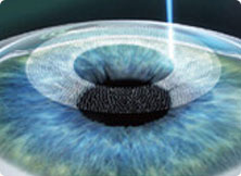 飞秒激光制作角膜瓣