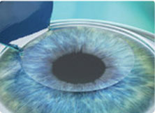 掀开角膜瓣