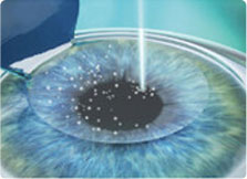 准分子激光扫描切割