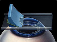 角膜板层刀制作角膜瓣