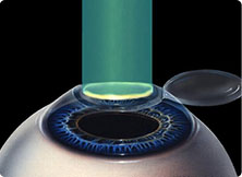 准分子激光切削