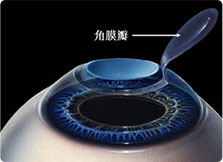 角膜瓣复位