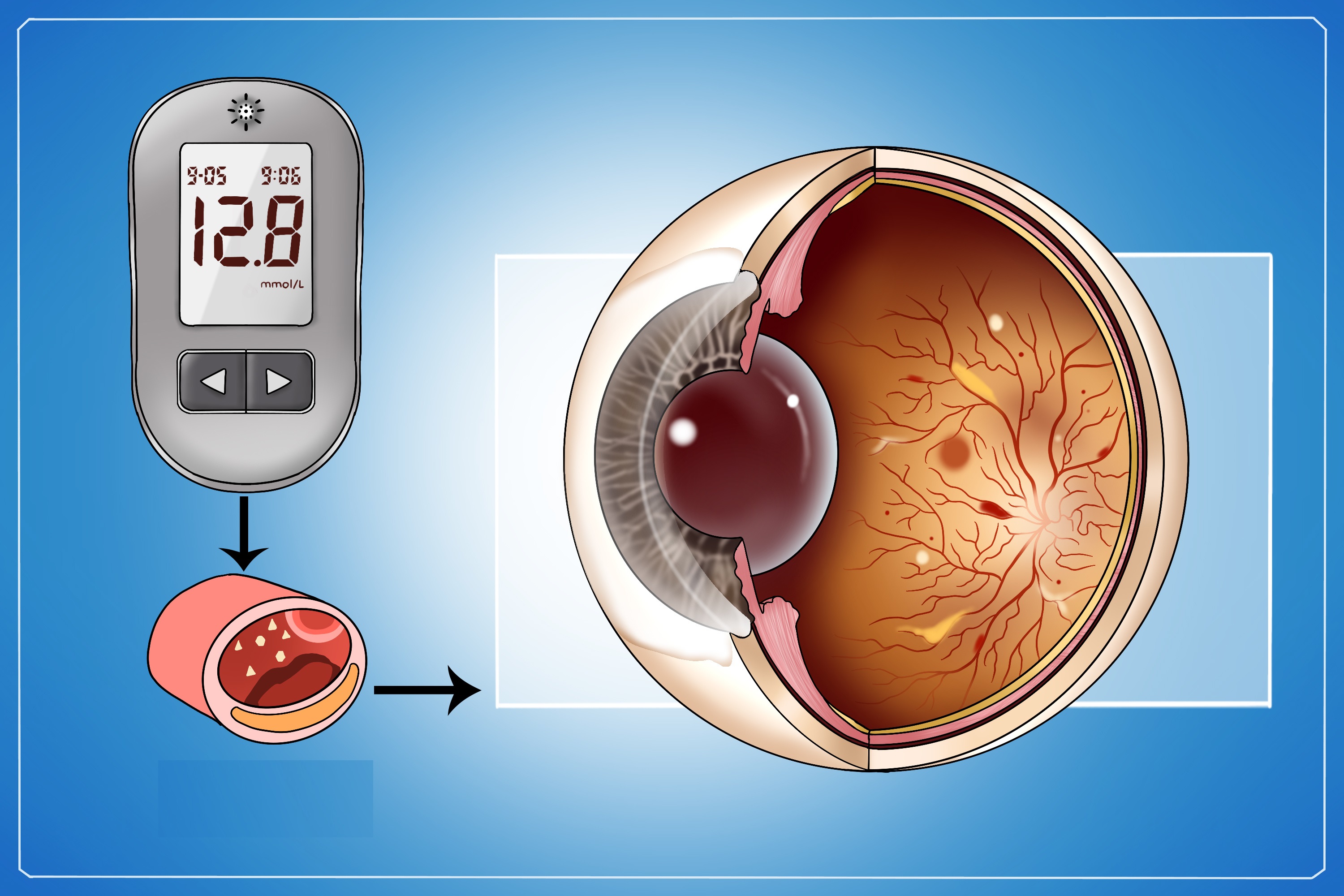 糖尿病视网膜病变是糖尿病常见的眼部并发症
