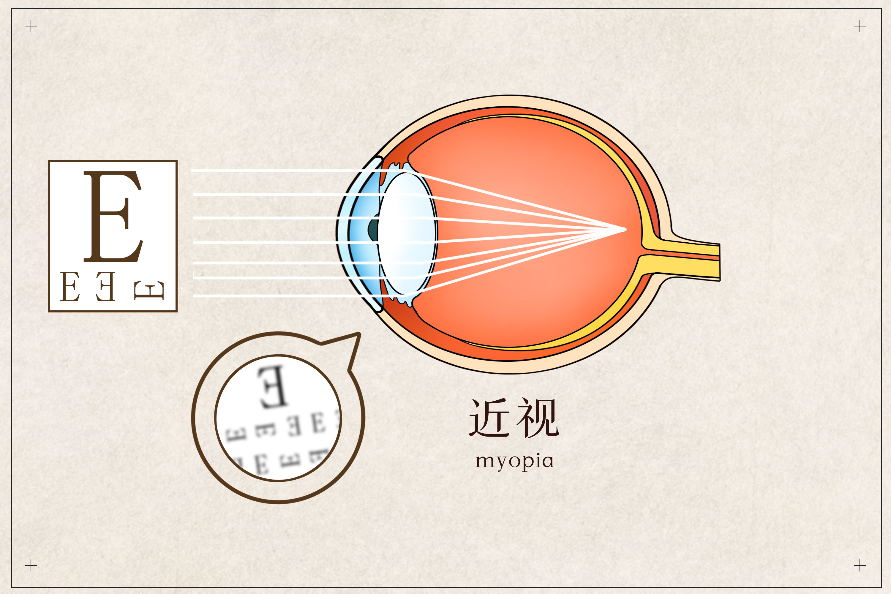 做完近视手术后多久可以玩手机
