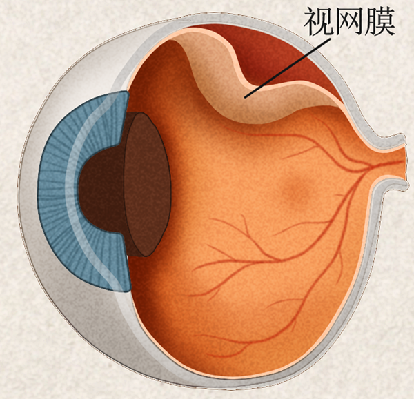 高度近视为什么需要定期做眼底检查？